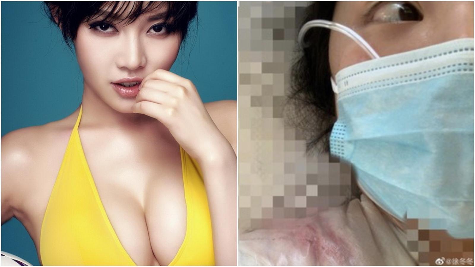 「中國第一美胸」徐冬冬貼出自己手術後的傷照，引起討論。（翻攝微博）
