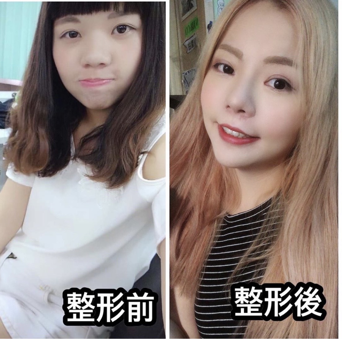 知名網路圖文插畫家超直白，繼年初動刀「修臉」，再次把腦筋動到胸部上。（翻攝自超直白IG）