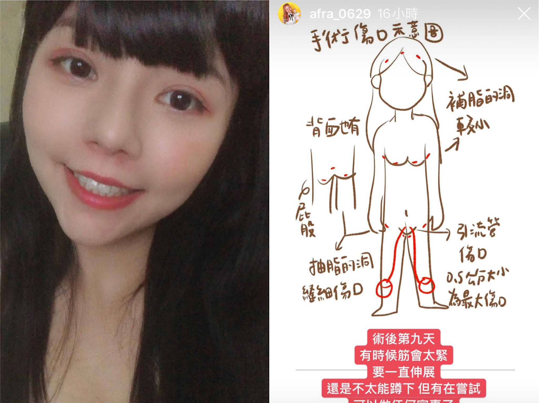 超直白運用自己的繪畫天分，讓好奇的網友知道自己隆胸手術後的傷勢。（翻攝自超直白IG）