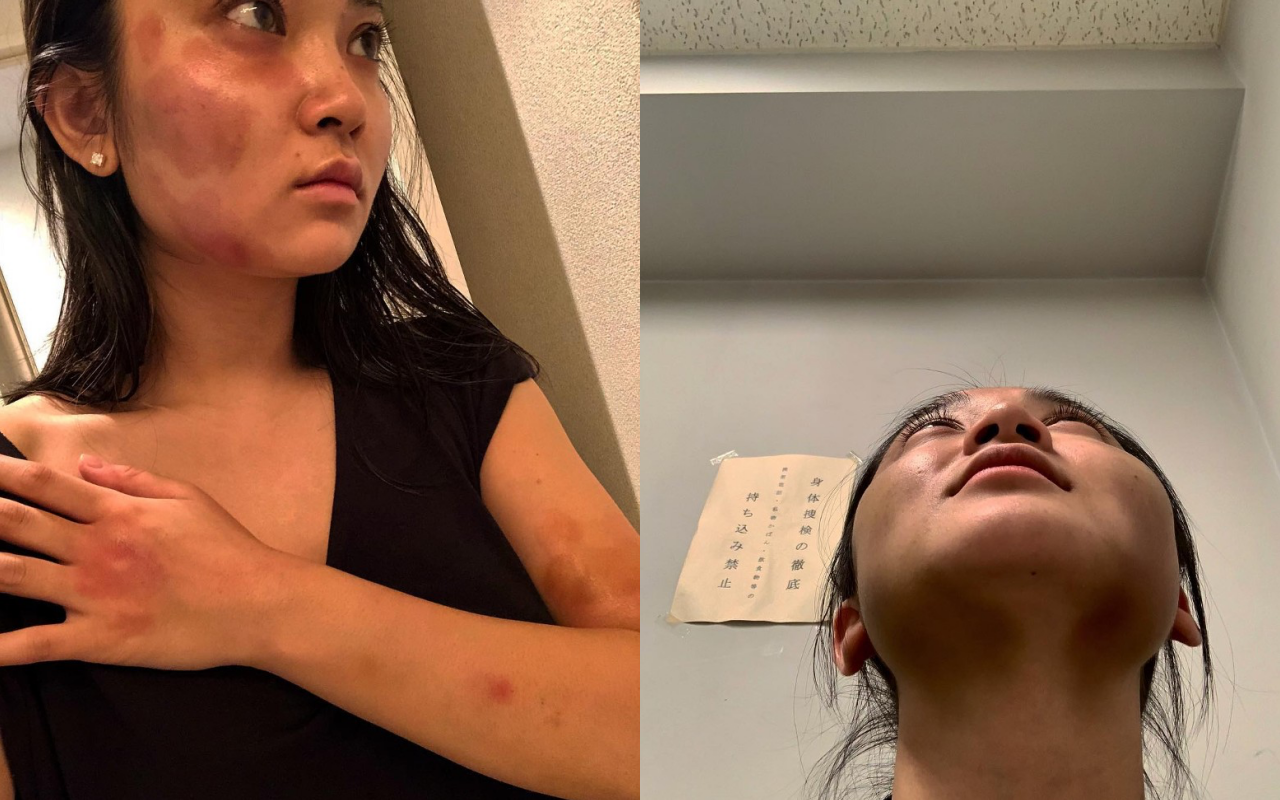 蔣勁夫前女友中浦悠花秀出她被蔣勁夫毆打的傷痕,觸目驚心。(網路圖片)