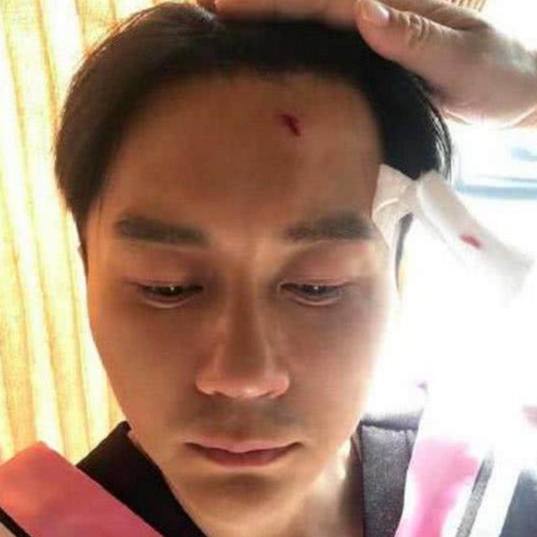 李晨曾在《跑男》摔破頭。（翻攝自李晨微博）