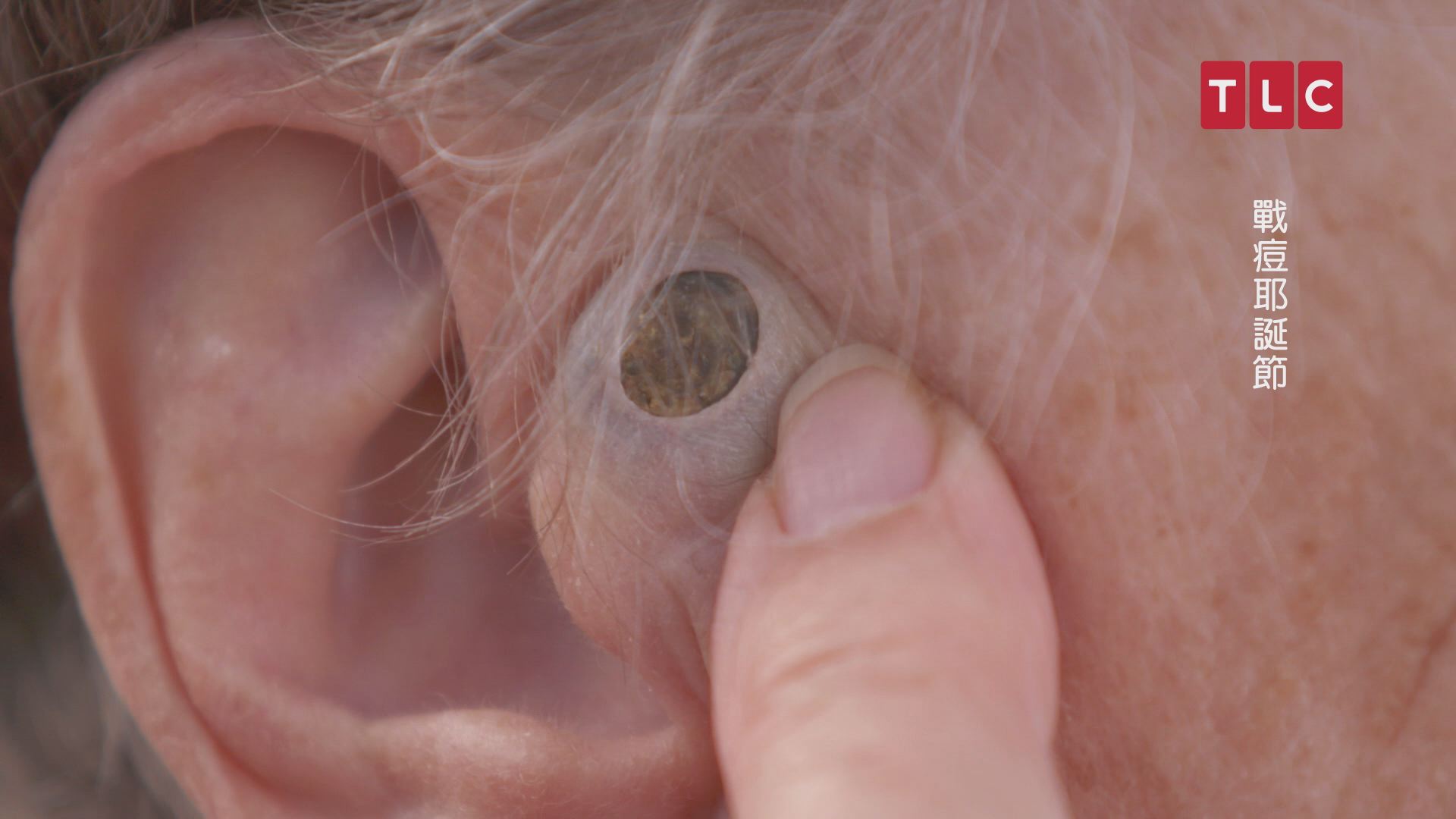 朵莉絲奶奶鬢角隱藏了一個超過半百歷史的超級黑頭，媲美巧克力豆。（TLC旅遊生活頻道提供）