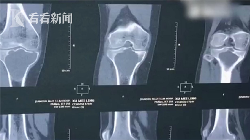 許多人都經歷過「生長痛」,但在中國,有人誤以為將惡性腫瘤的痛當成生長痛,造成延誤就醫,必須截肢。(翻攝看看新聞)