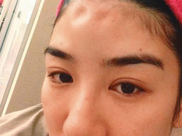 黃奕曾秀出驗傷單、額頭凹陷照片,指控前夫對她施暴。(翻攝自黃奕微博)