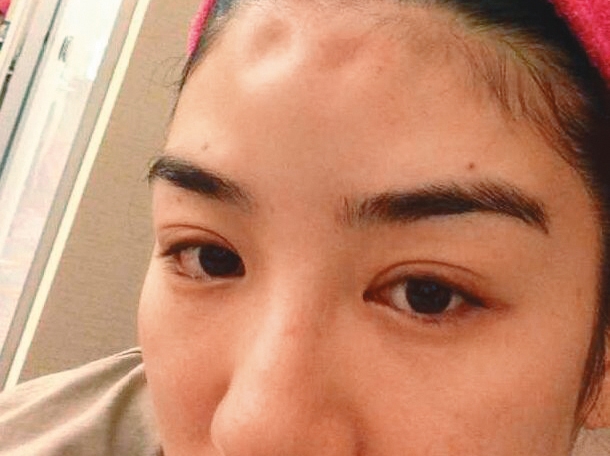 黃奕曾秀出驗傷單、額頭凹陷照片，指控前夫對她施暴。（翻攝自黃奕微博）