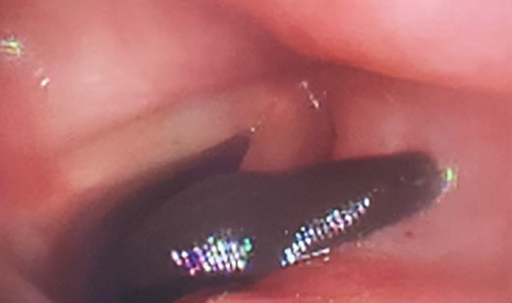 沈姓婦人長年居在山區，平常有用溪水漱口習慣，因此被水蛭寄生。（翻攝畫面）