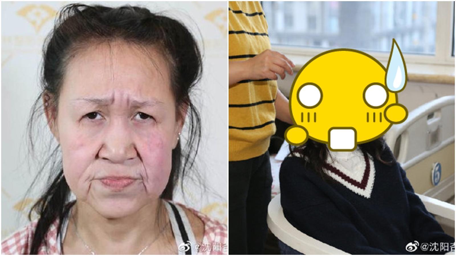 中國有一位女孩因罕病讓她看起來像老婦人,經過手術後「回到15歲」。(翻攝瀋陽杏林整形外科醫院微博)