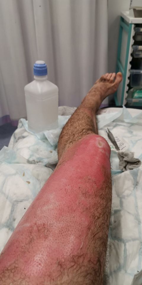 男子口袋裡的電子菸爆炸，導致左大腿三度灼傷，大腿燒到焦黑最後皮都不見了。（翻攝London Fire Brigade臉書）
