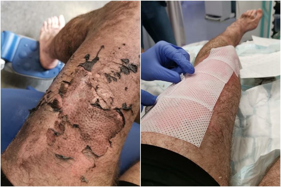 英國有男子日前將電子菸和鑰匙放在口袋，疑似因為摩擦導致爆炸。（翻攝London Fire Brigade臉書）