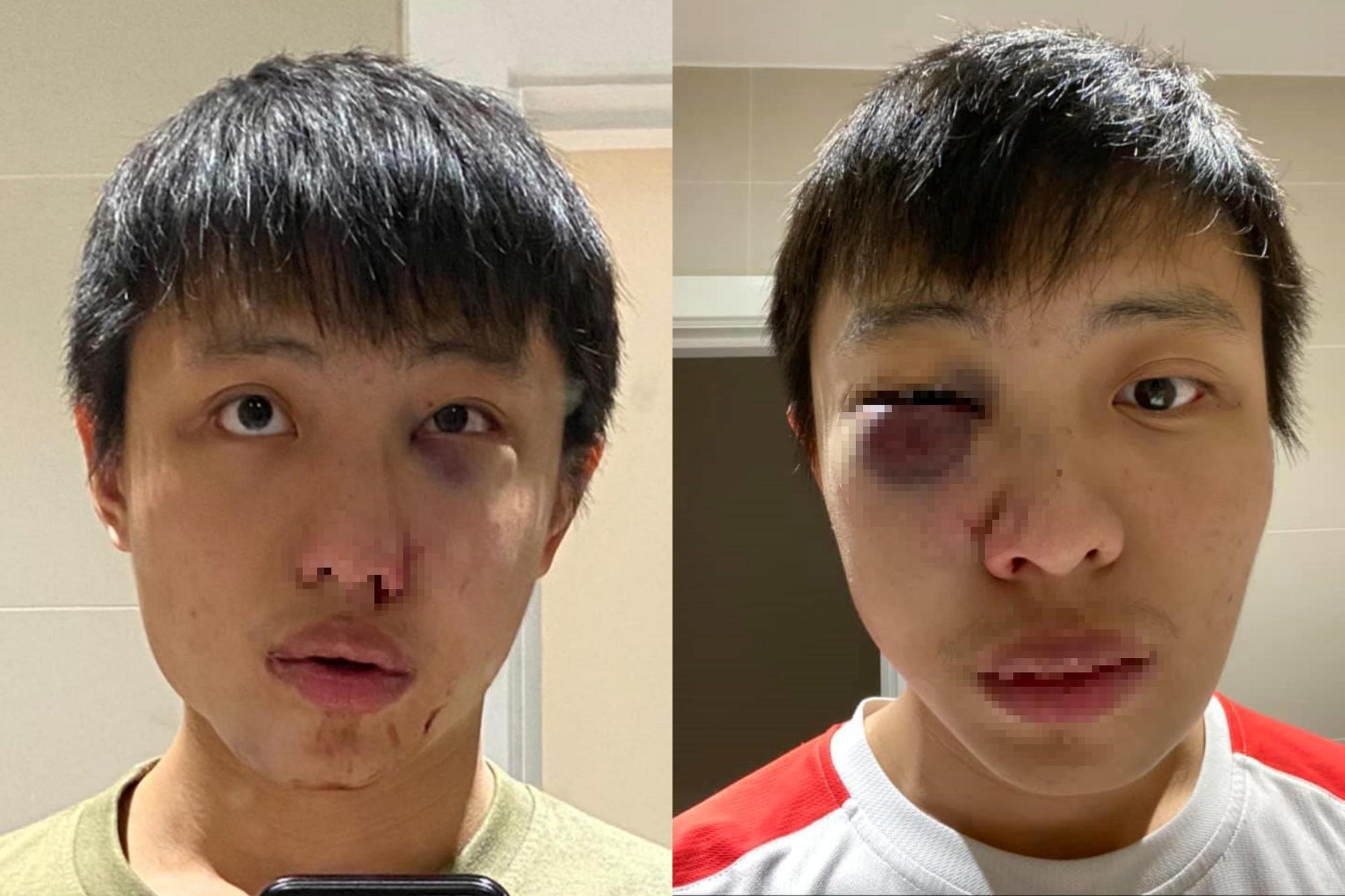 新加坡男子在倫敦遭到因種族暴力而起的暴力攻擊。（翻攝自臉書）