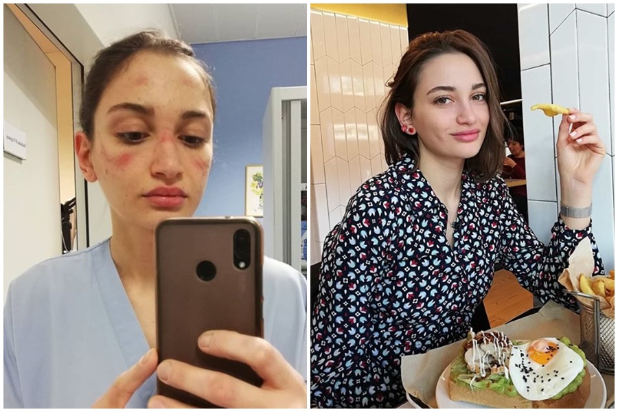義大利急診護理師艾莉西亞PO出滿臉勒痕的自拍照，吐露自己在防疫第一線的心聲。（翻攝自alessiabonari_IG）