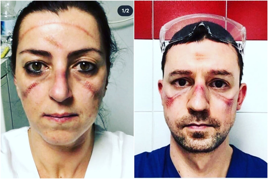 醫護人員拿下護目鏡後臉上被勒出暗紅色壓痕與瘀傷。（翻攝自covid_nurses IG）