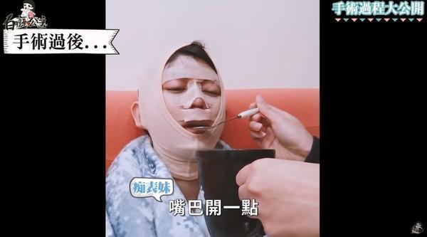 白癡公主臉部纏滿繃帶,得靠家人餵食食物。(翻攝自YouTube白癡公主)