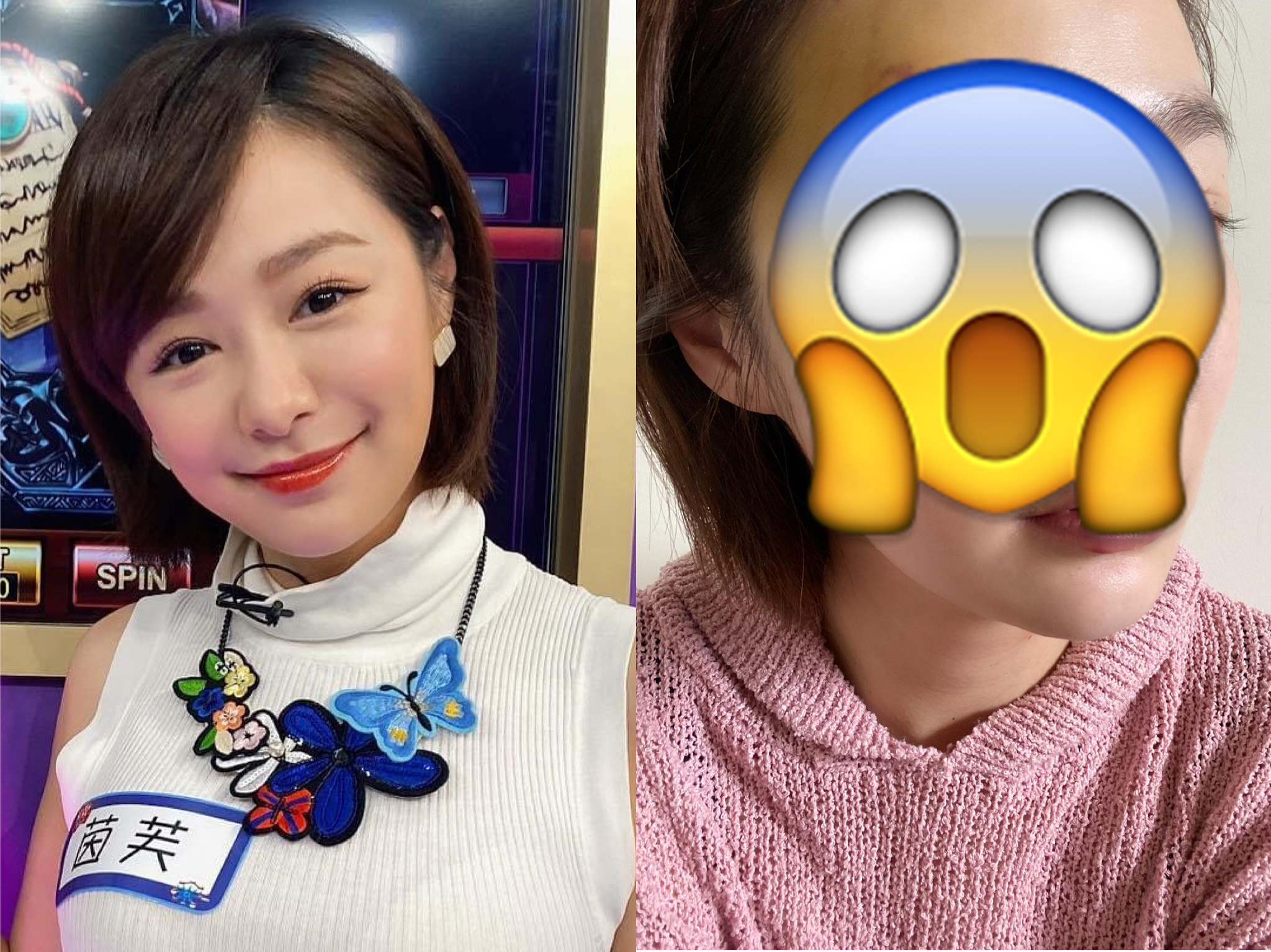 茵芙4月初在自家門口跌倒，眼周大片瘀青，看起來頗為恐怖。（翻攝自臉書、華人創作提供）