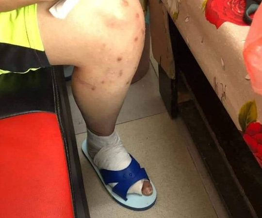 少年透露，自己在長期遭受電擊、痛毆的攻擊下，右腳已有3隻腳趾壞死。（翻攝彰化踢爆網）