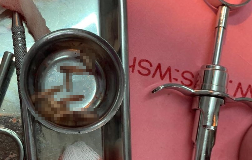 阿薩瓦在老翁牙齦裡拉出12條「活生生的白蛆」。（翻攝自Thanatnon Rong Assava臉書）