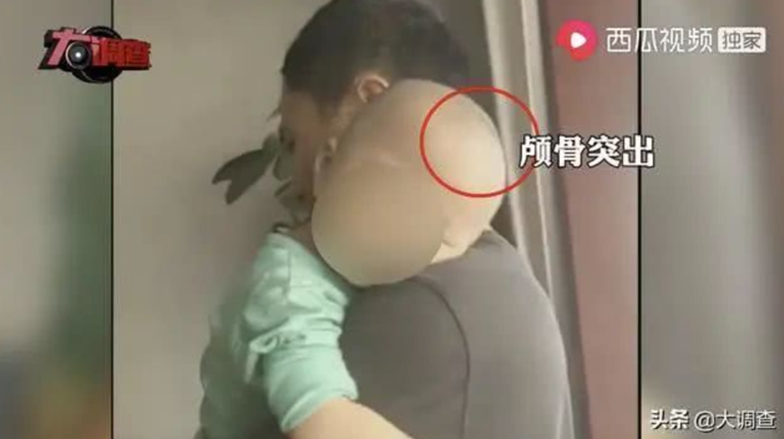 中國再度爆發假奶粉事件,由固體飲料冒充,導致孩童營養不良出現畸形。(翻攝自網路)