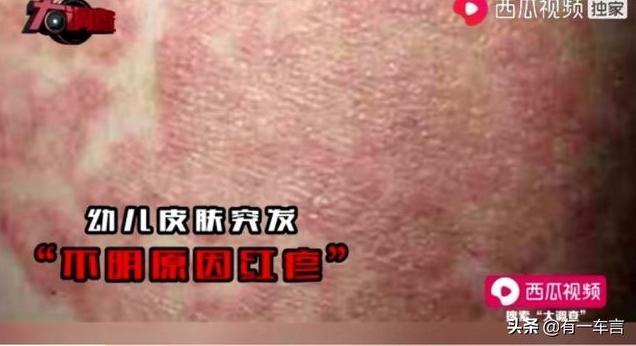 兒童喝下該奶粉,不僅體重變輕、頭骨發育畸形,身體還會出現大面積濕疹。(翻攝自網路)