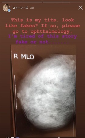 Hitomi貼出胸部X光照，證明自己並未隆乳而是真材實料。（翻攝自Hitomi IG）