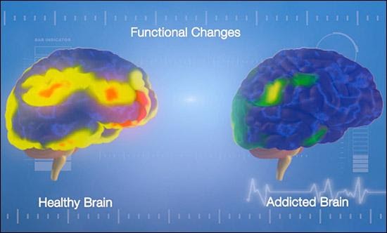 藥物濫用成癮對大腦的影響。左為健康腦；右為成癮腦。（inspiremalibu官網）