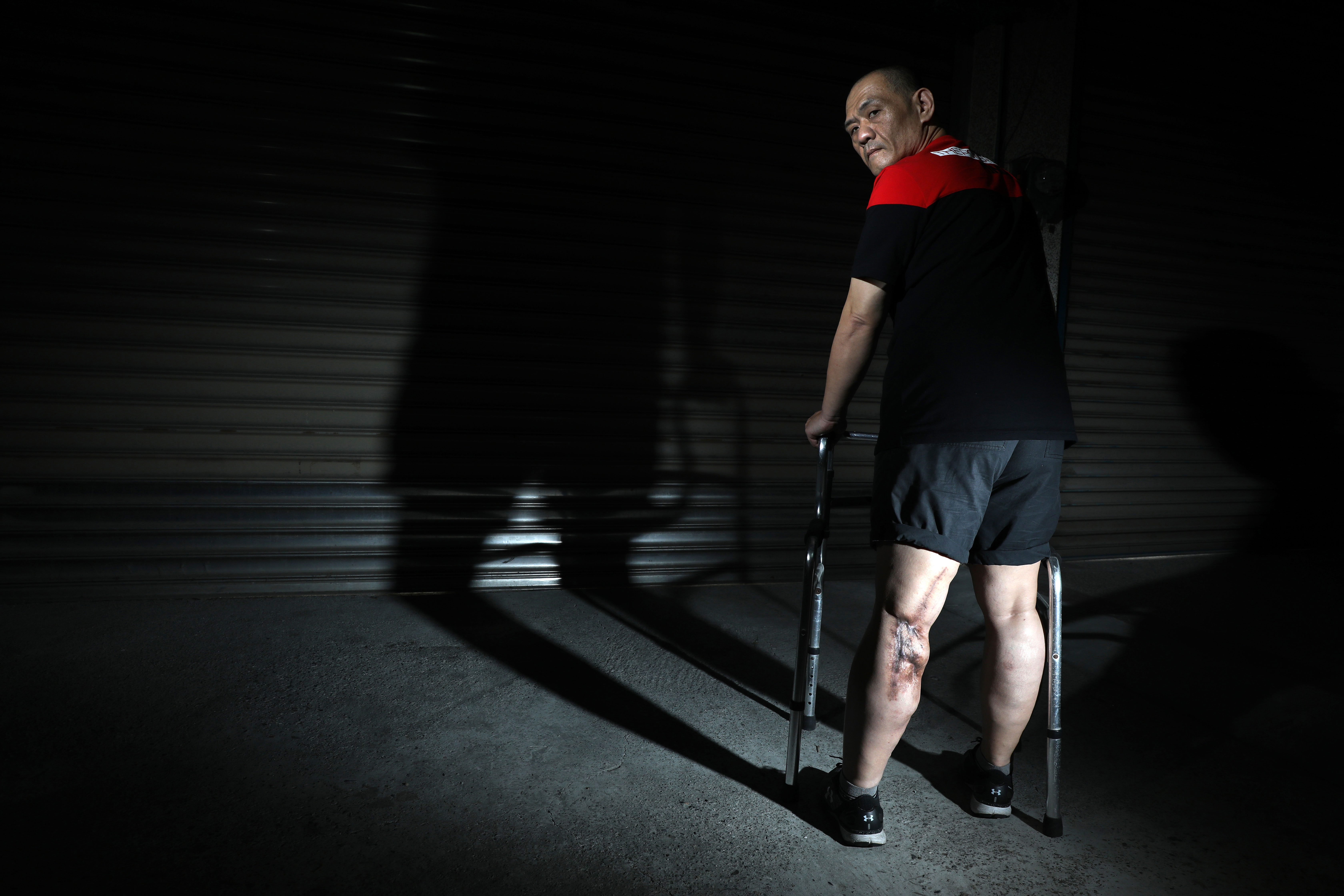 車禍留下嚇人的疤痕，愛美的曾仲志說未來若雙腿狀況好一些，想去刺青掩蓋那些可怕傷疤。