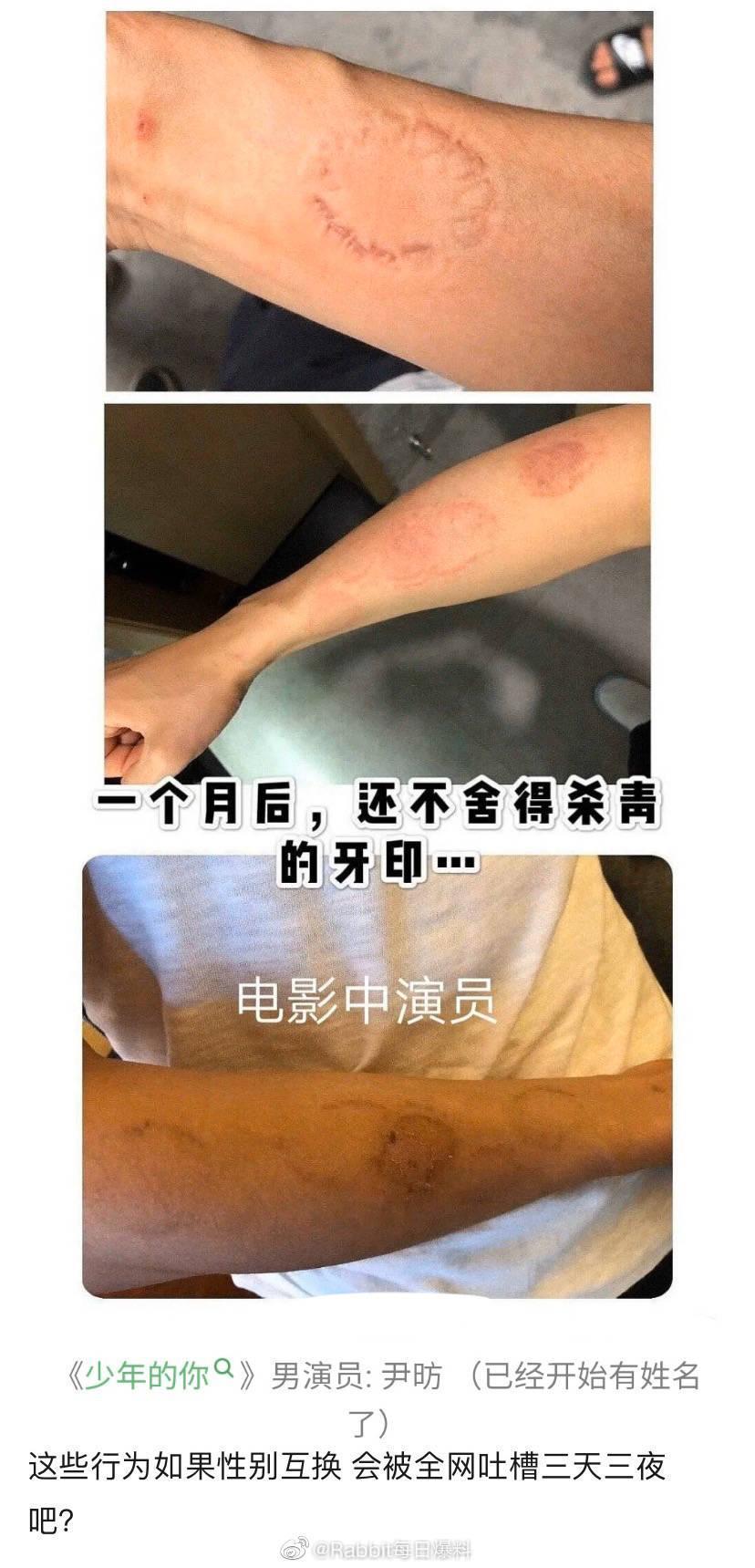 周冬雨拍《少年的你》時因劇情需要咬了同片演員的手臂，事隔一個月痕跡依舊存在。（翻攝自Rabbit每日爆料微博）