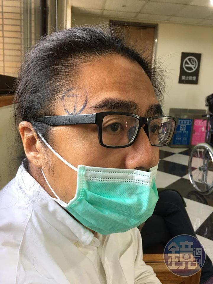 開刀前,周易正的頭部右側被劃上標記,我問他為什麼?他說:「沒有的話,醫生可能會開錯邊。」(周易正提供)