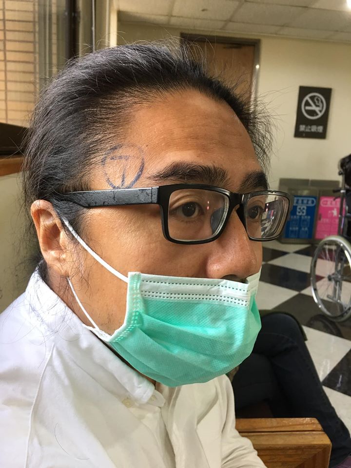 開刀前,周易正的頭部右側被劃上標記,我問他為什麼?他說:「沒有的話,醫生可能會開錯邊。」(周易正提供)