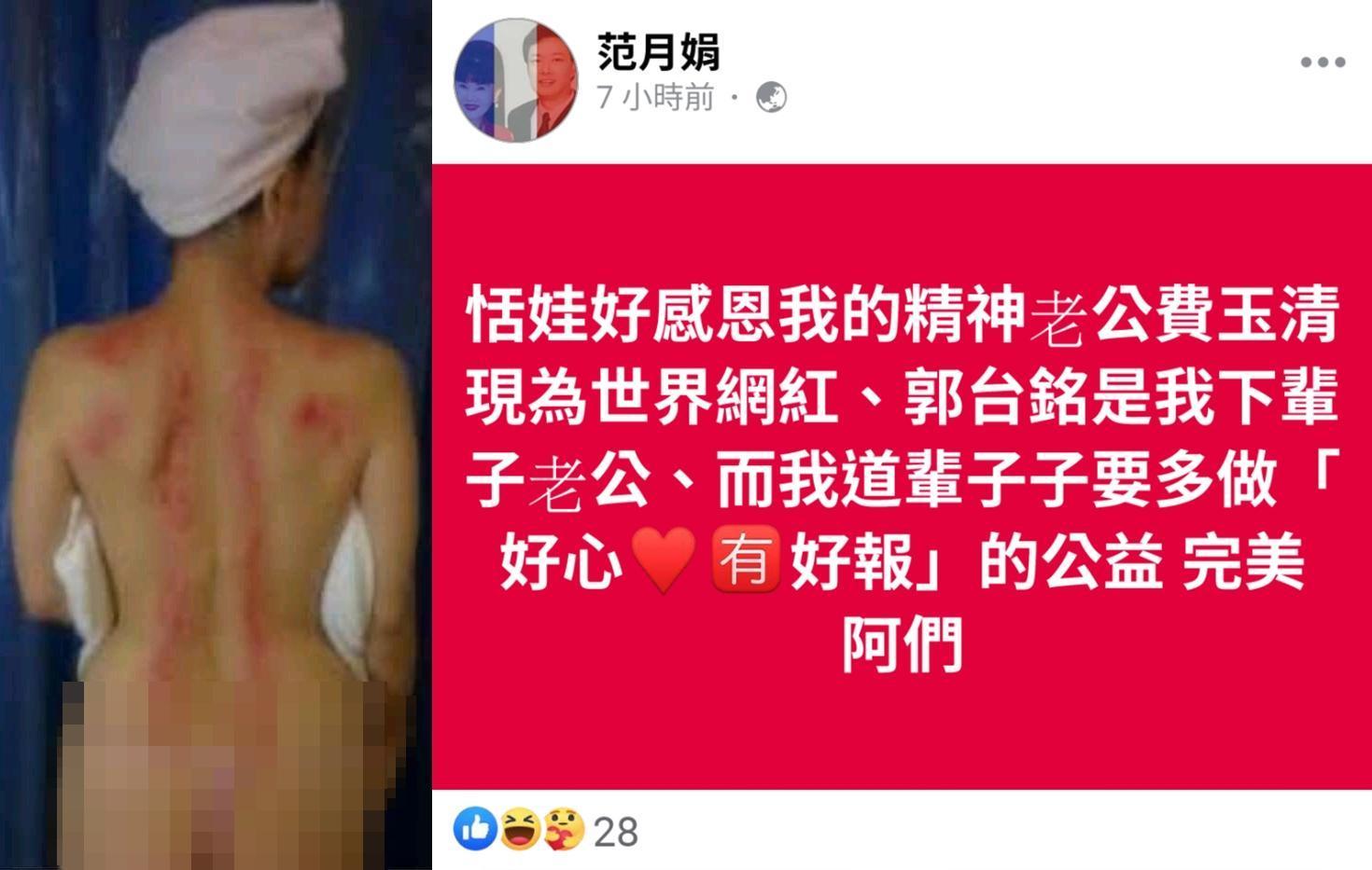 恬娃曬出背後裸照，67歲的她有這種身材實屬不易，但身上刮痧血痕看得令人驚心。（翻攝自范月娟臉書）