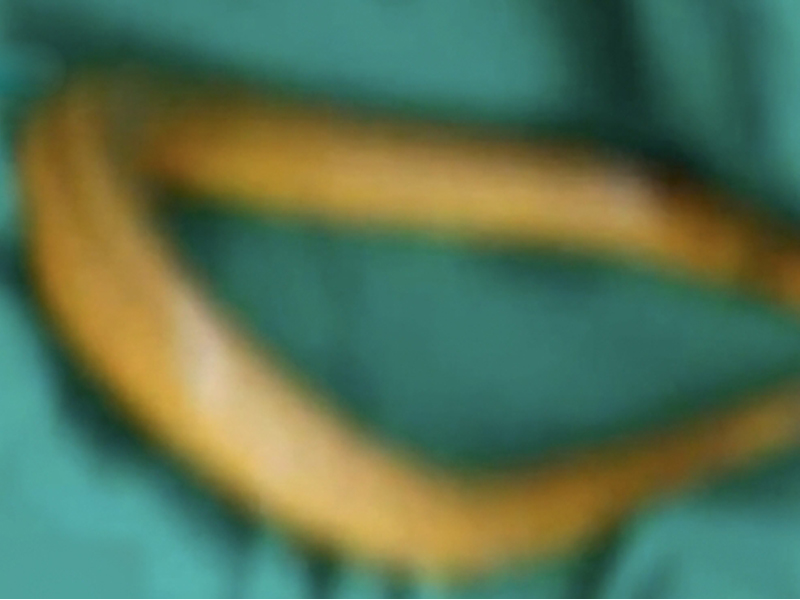 中國男子誤信「黃鱔可通便」，險些感染喪命。（翻攝自網路）