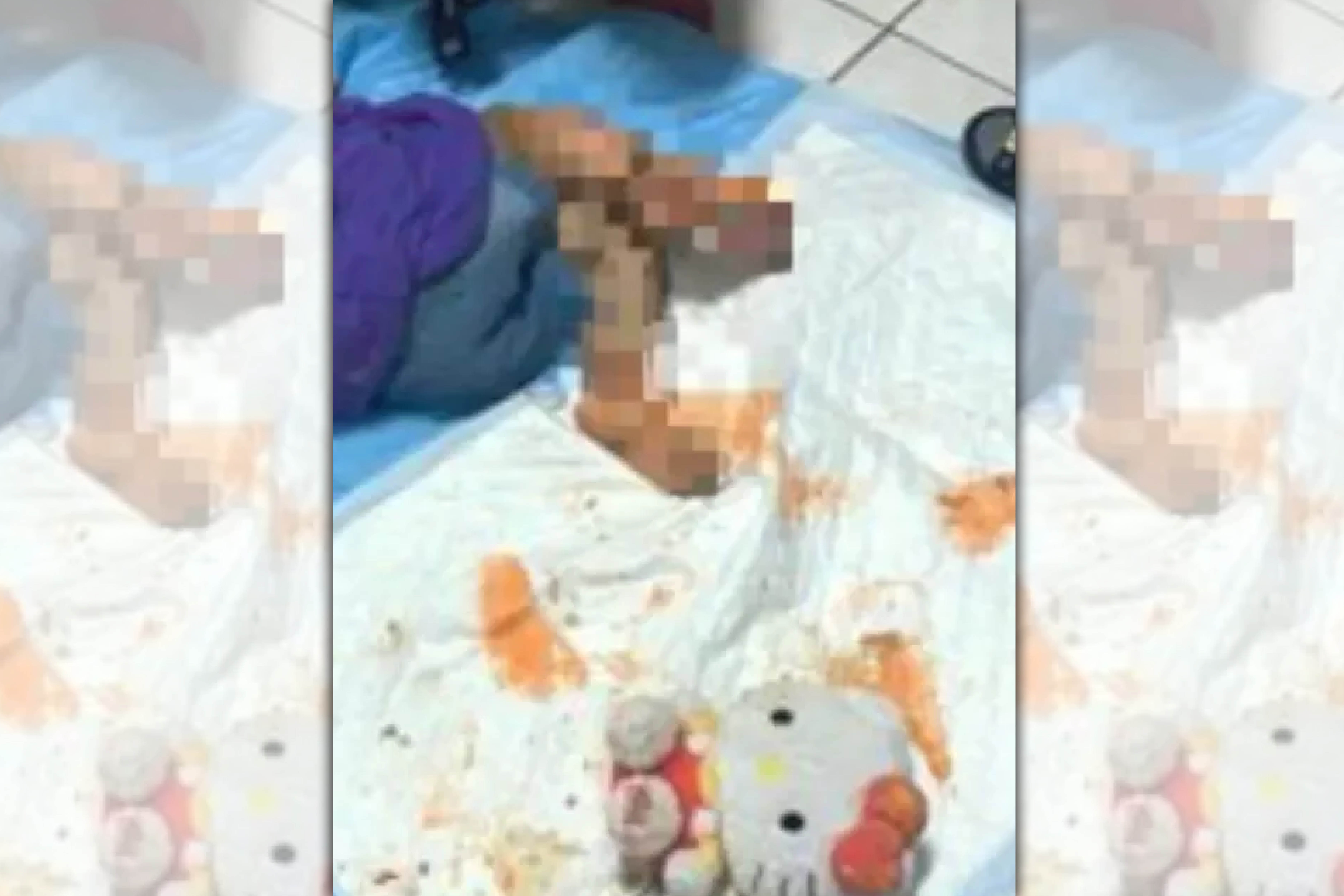 女童2週前遭燙傷，家屬竟未帶女童就醫，導致傷口嚴重惡化。（翻攝自臉書）