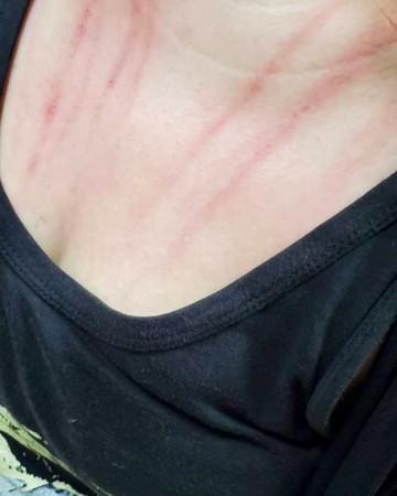 Keanna經紀人指控被莉婭推,曬出胸前抓痕照。(翻攝自Keanna經紀人IG)