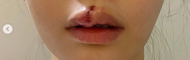 趙慧珊被狗咬後迅速就醫。（翻攝趙慧珊IG）