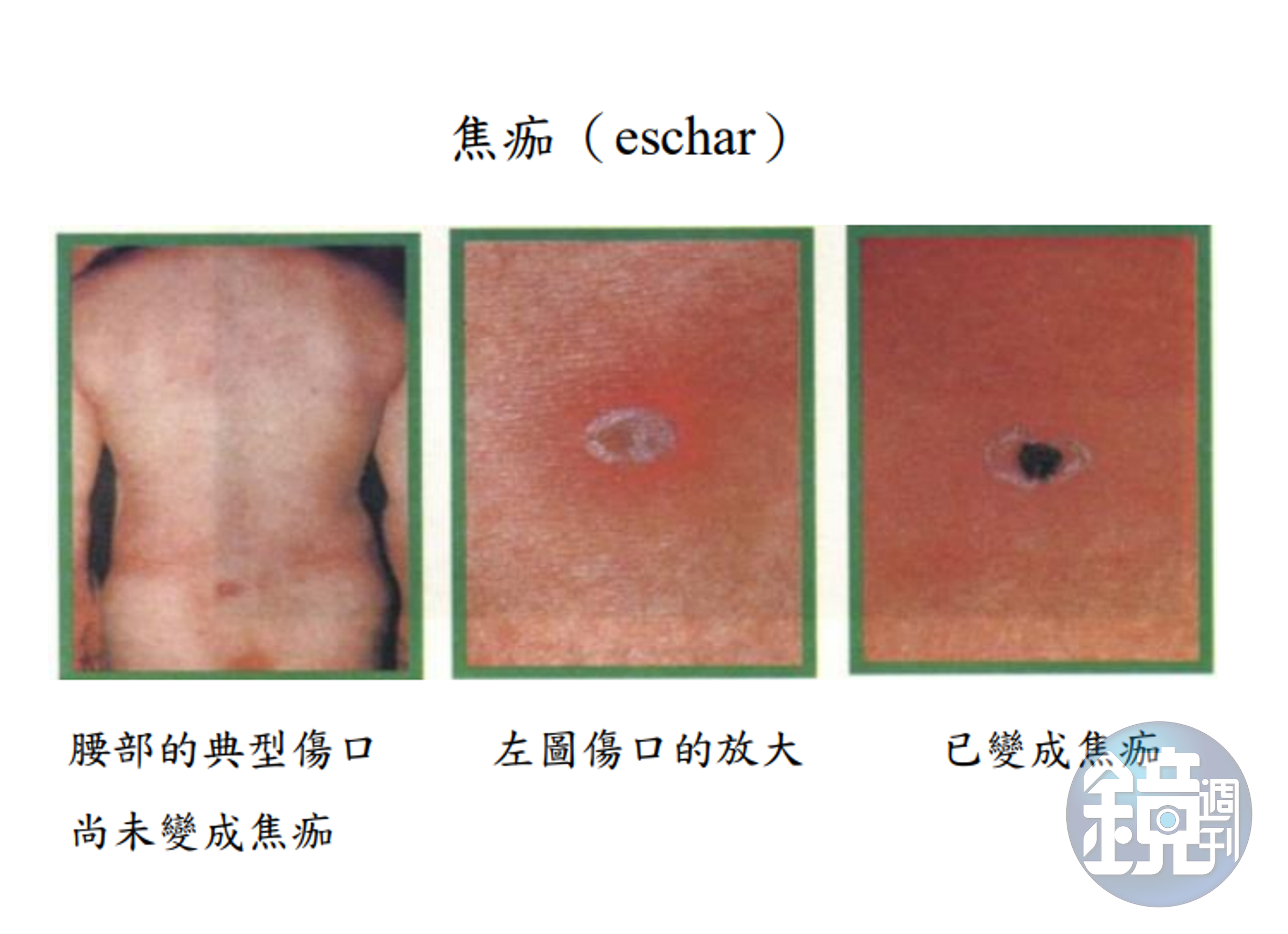 疾管署〈認識恙蟲病〉一文中附上的焦痂（eschar）示意圖。（翻攝疾管署）