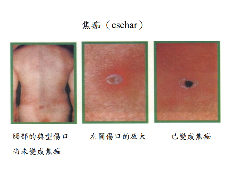疾管署〈認識恙蟲病〉一文中附上的焦痂（eschar）示意圖。（翻攝疾管署）