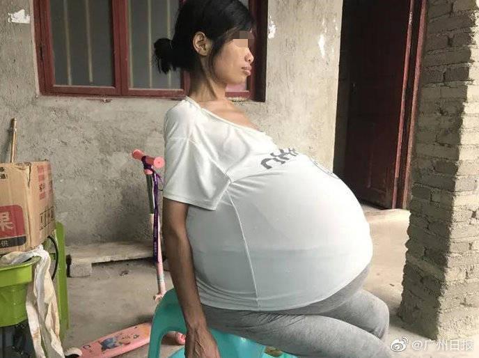中國貴州的黃國嫻肚子在2年內脹大,這樣的大小讓她只能「坐著睡」。(翻攝光明網)