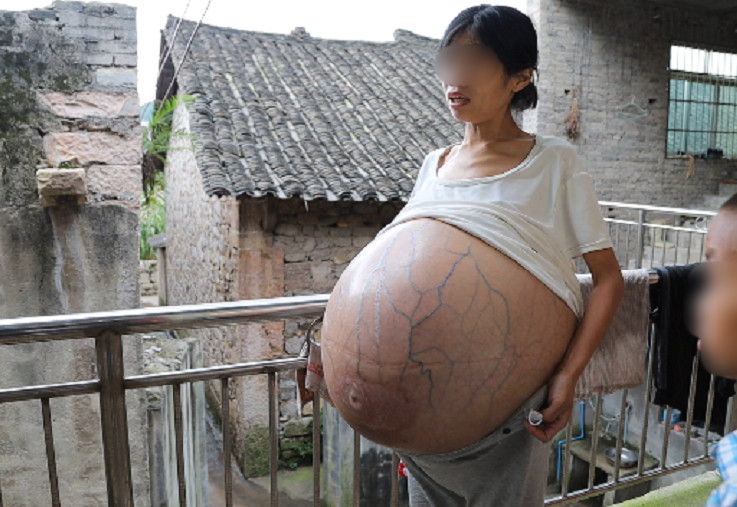 婦人搭公車時還被懷疑是否懷「多胞胎」，讓她難以解釋。（翻攝光明網）