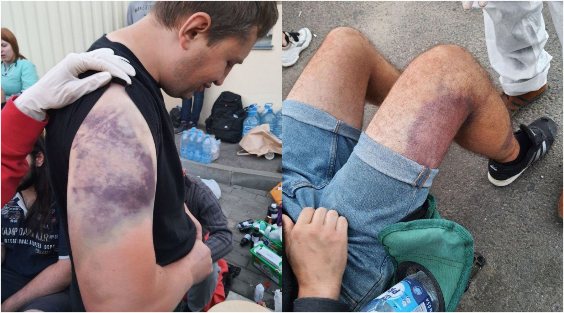 民眾指控被警察拘捕毆打虐待，秀出身上的傷痕。（翻攝https://www.svaboda.org/）