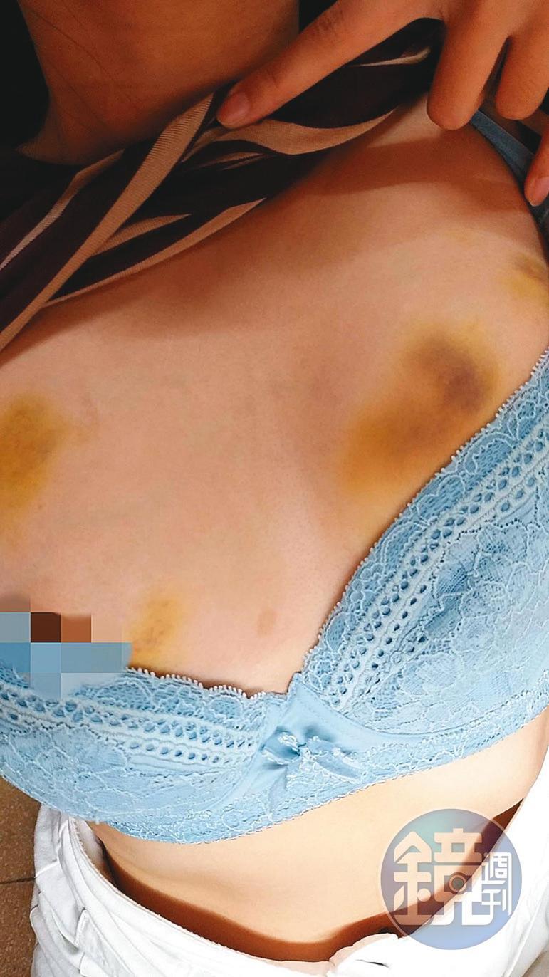 謝男前女友小玉控訴,謝男只要動怒,就會動手打人,她胸前的一片瘀青,就是謝男施暴的結果。(讀者提供)