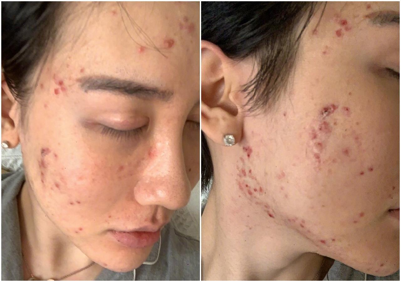 劉梓晨上傳全臉潰爛照,引發網友熱議。(翻攝自劉梓晨微博)