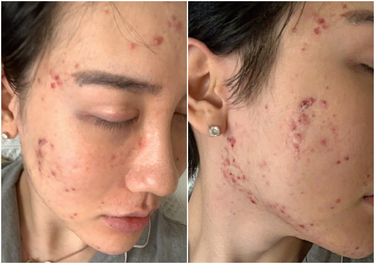 劉梓晨上傳全臉潰爛照,引發網友熱議。(翻攝自劉梓晨微博)