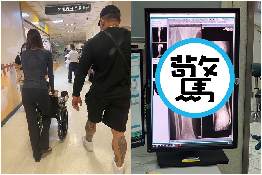 館長帶兒子複診，並曝光小孩的X光片。（翻攝自飆捍臉書）