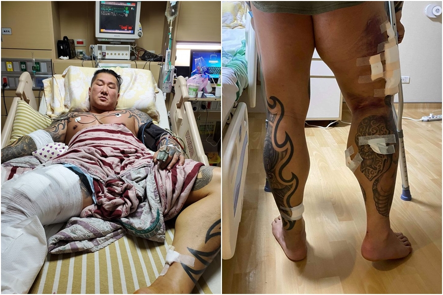 館長右腿腫脹照片曝光。（翻攝自飆捍粉絲專頁）