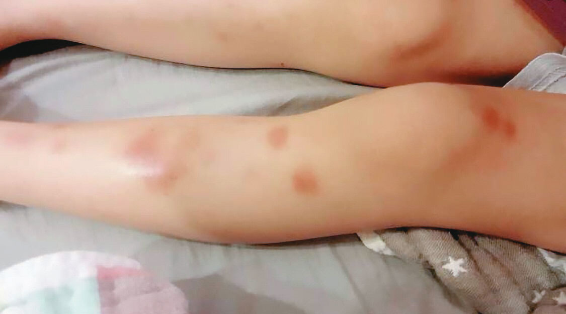 凱斯幼兒園受虐孩童被老師拖行，小腿出現瘀青。