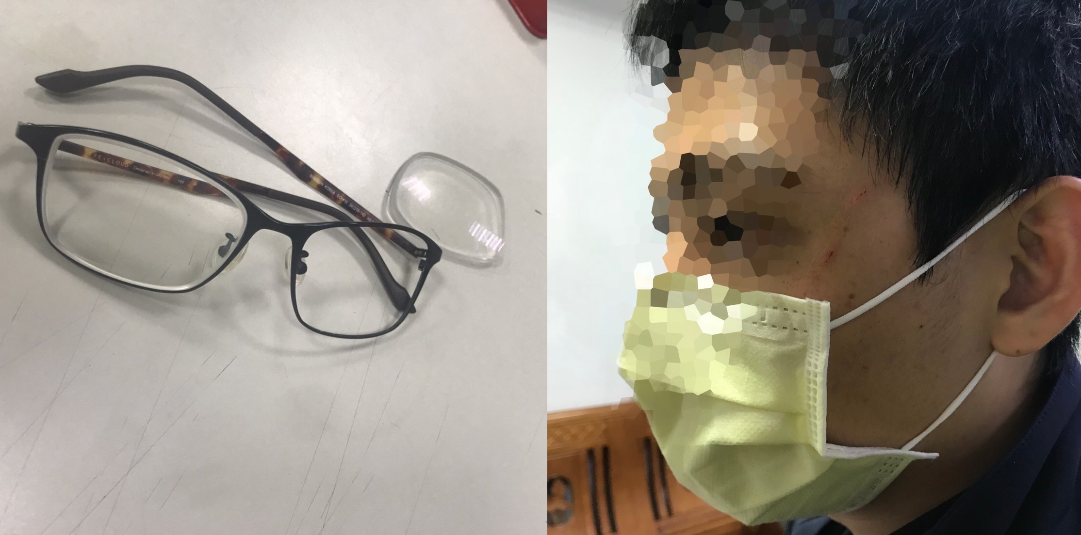 眼睛遭余女攻擊的王姓員警。（警方提供）