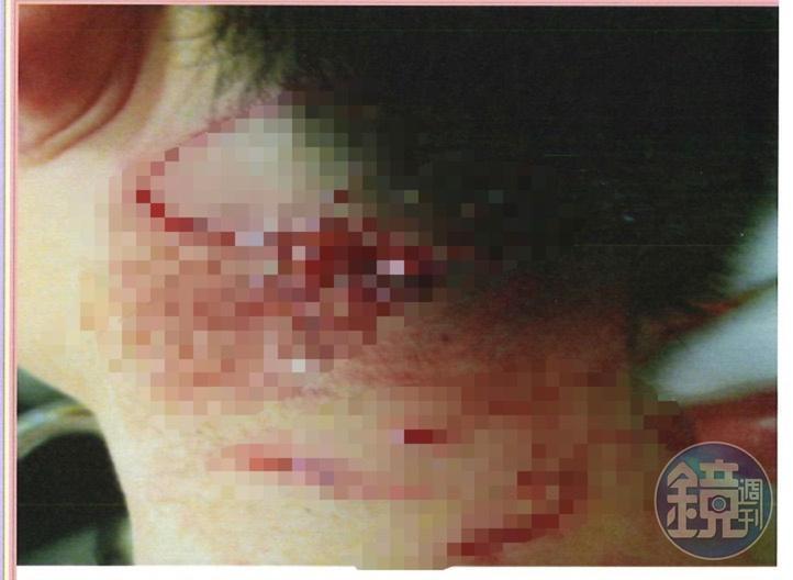 康橋校園前年有野狗闖入,受害同學頸部及四肢、大腿皆被咬傷,送醫搶救縫90多針才保住性命。(讀者提供)