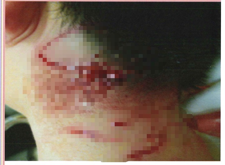 康橋校園前年有野狗闖入，受害同學頸部及四肢、大腿皆被咬傷，送醫搶救縫90多針才保住性命。（讀者提供）