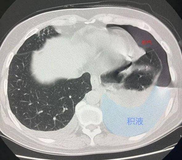 生吃螃蟹半年後,大媽胸腔內滿滿都是氣泡和積水。(取自浙江之聲)