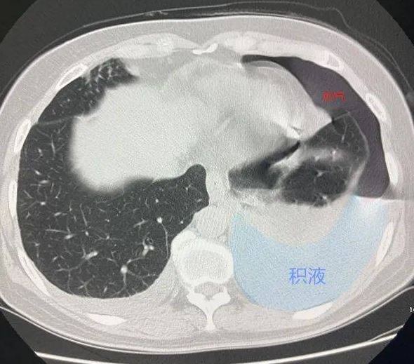 生吃螃蟹半年後,大媽胸腔內滿滿都是氣泡和積水。(取自浙江之聲)