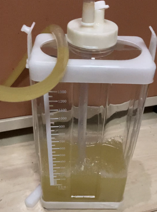 大媽接受穿刺引流手術,胸管內流出了大量的膿性液體,相當驚人。(取自浙江之聲)